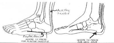 Plantar Fasciitis